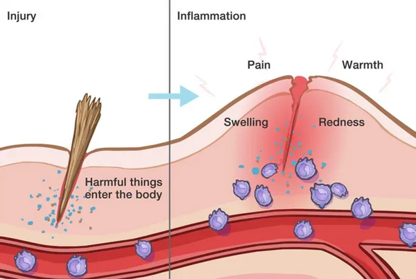 Neuroinflammation and TBI